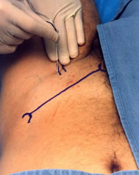 Photo femoral nerve block