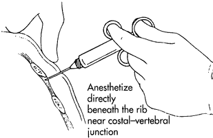 Drawing of Intercostal block lateral view