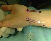 Ulnar Nerve Block