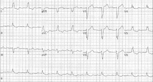 True LBBB. Note NO Q wave in lateral leads