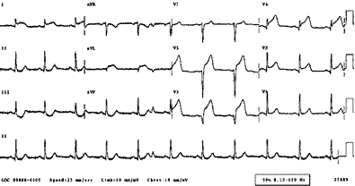 ECG showing Anterior AMI