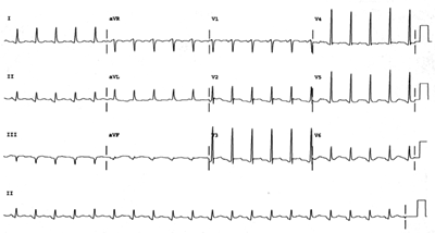 ECG - Anterior AMI