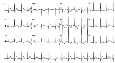 ECG Showing posterior AMI