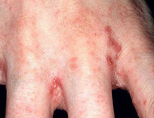 Scabies Images On Legs