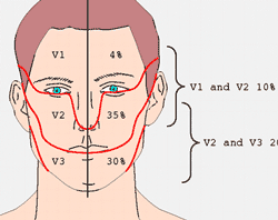 Distribution Trigeminal Neuralgia