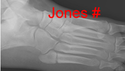 Jones fracture (proximal shaft) 5MT, not base MT