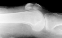 Patellar fracture lateral view