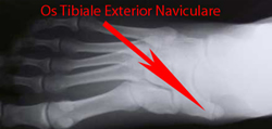 Os tibiale Ext Navicular