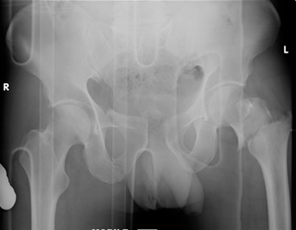 Shear pelvic fracture with femoral neck fracture