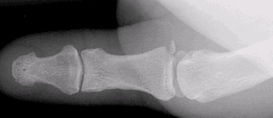 Gamekeepers thumb x-ray fragment