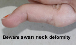 Swan neck deformity