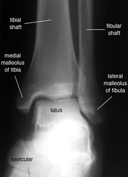 Ankle AP labelled