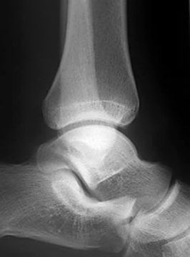 x-ray ankle lateral