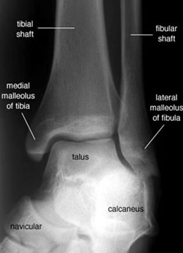Ankle mortise labelled