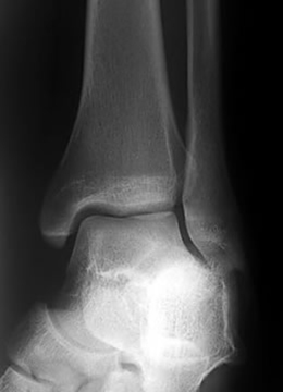 x-ray ankle mortise