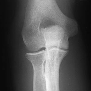 x-ray elbow AP view
