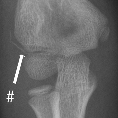 Lateral Epicondyle fracture