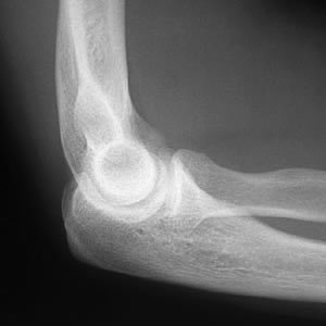 x-ray elbow lateral view