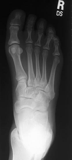x-ray foot AP