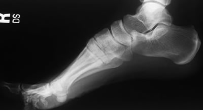 x-ray Foot lateral