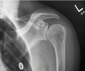 x-ray shoulder AP