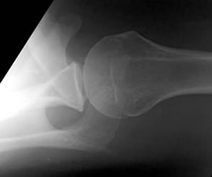 x-ray shoulder Axillary View