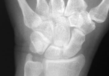 x-ray wrist PA view