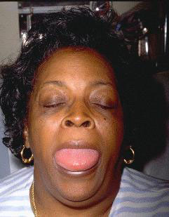 Significant tongue swelling in angio-oedema case
