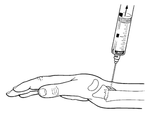 Diagram lateral view Haematoma Block