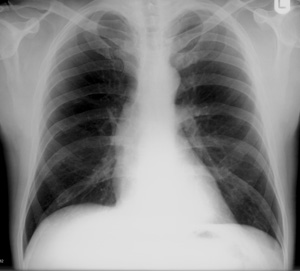 aortic dissection x ray