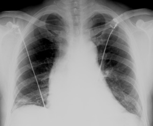 Aortic Dissection at Presentation