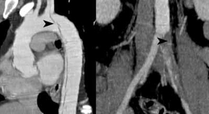 Dissection Stanford B. Three dimensional reconstruction from the computed tomography angiogram showing the aortic arch and the iliac bifurcation. The left arrow shows the intimal flap and the right arrow indicates the occluded left commom iliac artery