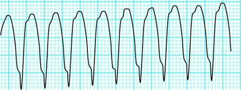 Monomorphic VT