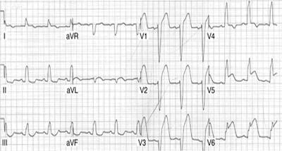 ECG - SCARBOSSA criteria in LBBB