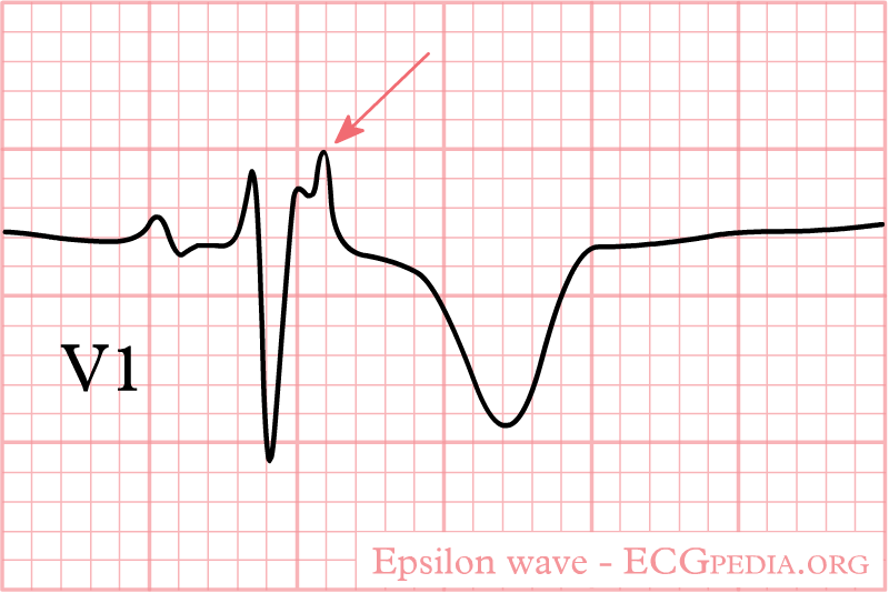arvd - epsilon wave