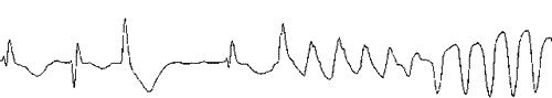 Torsade de Pointes rhythm strip - Thank you Dr Peter Kearney