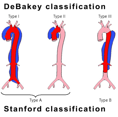 emed.ie Iomhar DEBakey and Stanford Classifications