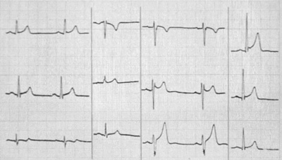 Pericarditis