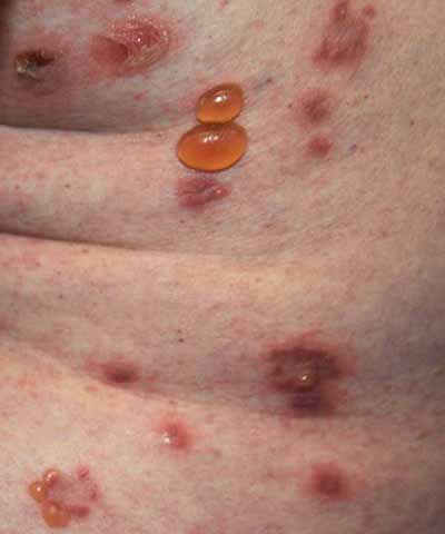 Bullous Pemphigoid - From BMJ 2013