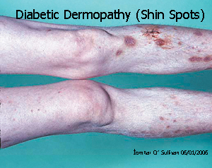 diabetic dermopathy icd 10)