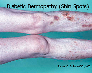 Diabetic Dermopathy Condition, Treatments and Pictures for Adults