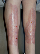 Necrobiosis Lipoidica Shins