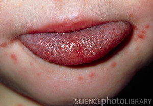 Coxsackievirus Painful Yellow lesion with red Halo. Thanks to SciencePhotoLibrary