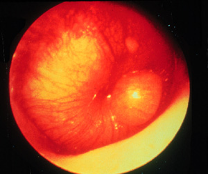 Acute Suppurative Otitis Media<br>with inflammation and loss of anatomical details and light reflex