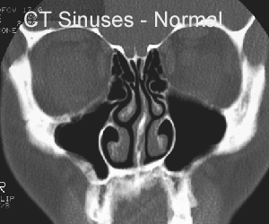 CT amxilla normal