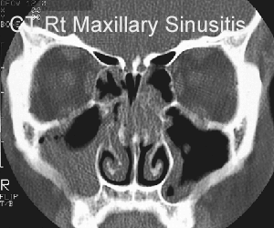 CT maxilla sinusitis