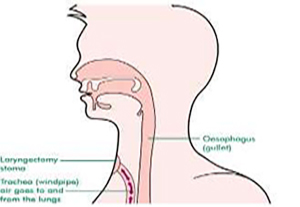 Laryngectomy anatomy