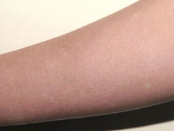 Dengue Rash is typically faint, erythematous and macular