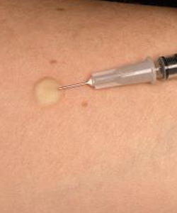 Mantoux should raise bleb confirming intradermal injection