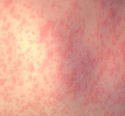 Measles on day 3